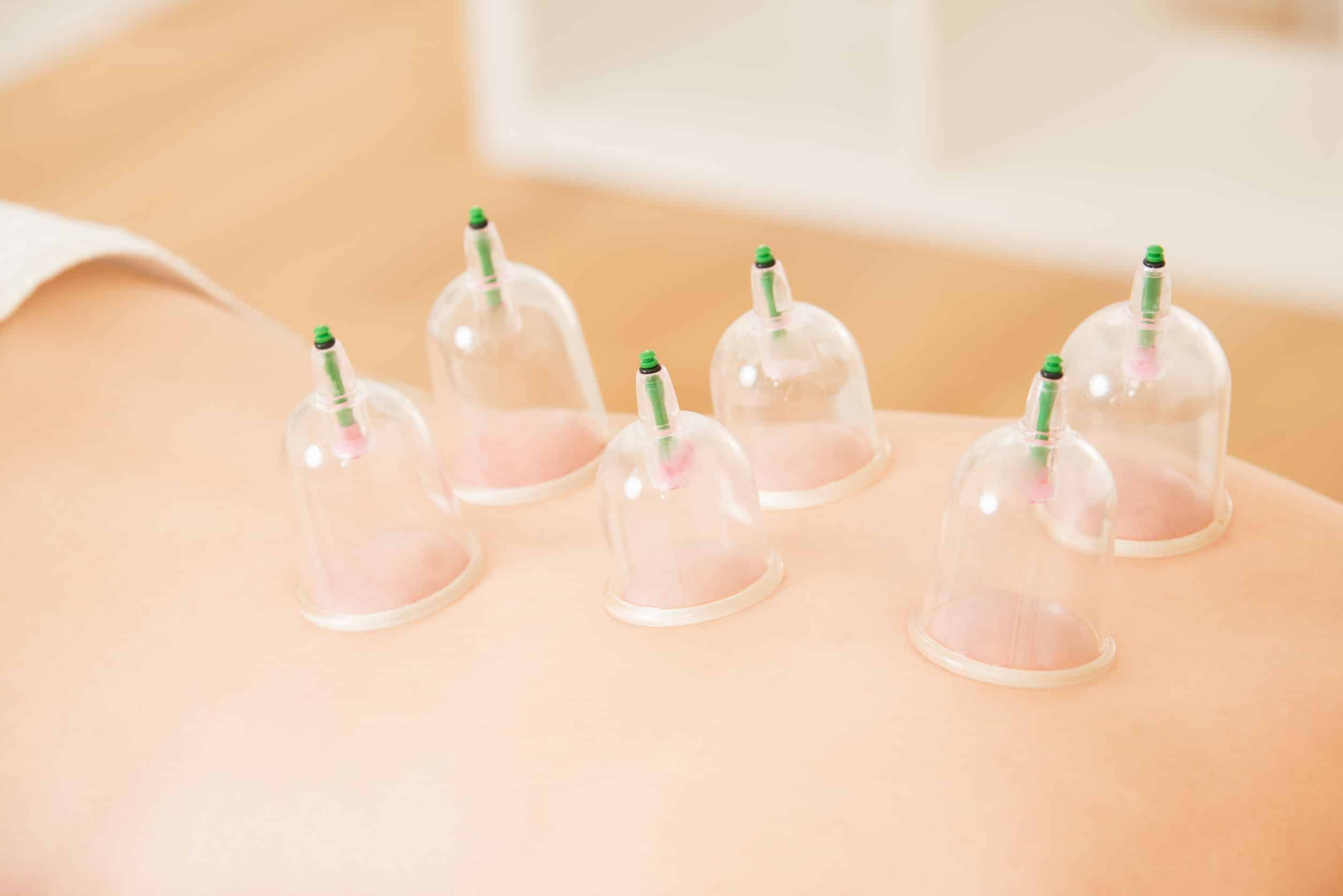 Cupping Massage